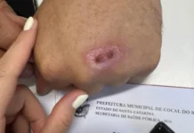 Saúde de Cocal do Sul acompanha caso de esporotricose e reforça orientações à população